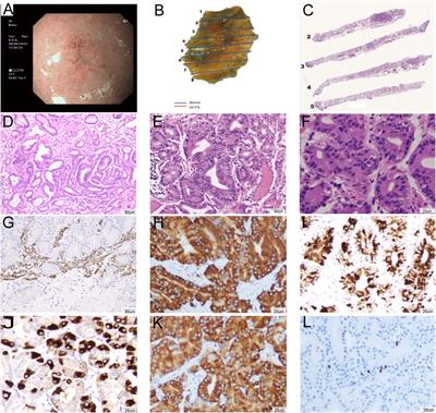 Gastric epithelial neoplasm of fundic-gland mucosa lineage: representative of the low atypia differentiated gastric tumor and Ki67 may help in their identification